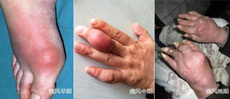 成都西部痛风风湿医院